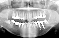 治療後のパノラマX線写真