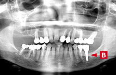治療後のパノラマX線写真
