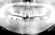 治療前のパノラマX線写真