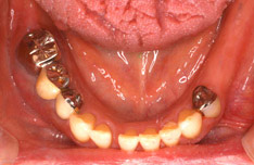 治療前のお口の中の状態（下顎）