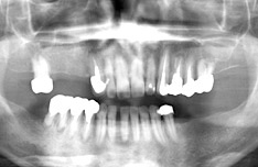 治療前のパノラマX線写真