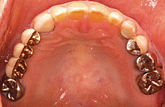 治療後のお口の中の状態（上顎）