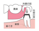 コーヌス クローネタイプ（取り外し式）