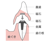 マグネット（磁石）タイプ（取り外し式）