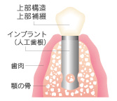 インプラント（埋め込み式）