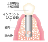 インプラント(埋め込み式)