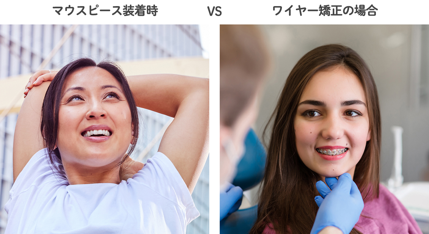 マウスピース装着時VSワイヤー矯正の場合