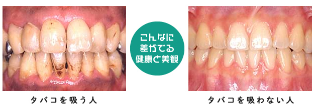 タバコを吸う人と吸わない人の口の中