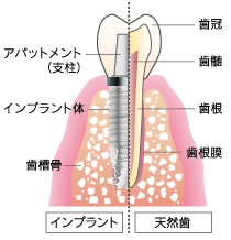 インプラントとは