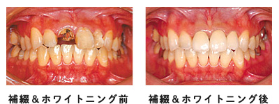 補綴&ホワイトニング症例写真