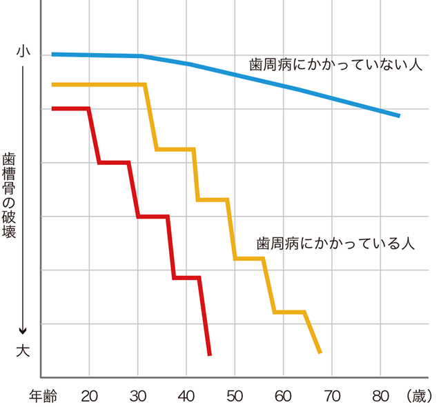 年齢と歯槽骨の破壊量の関係を示したグラフ。歯周病にかかっていない人は加齢とともに緩やかに減少するのに対し、歯周病にかかっている人は段階的に大きく減少し、重度の場合は若い年代から急激に歯槽骨が失われることを示している。