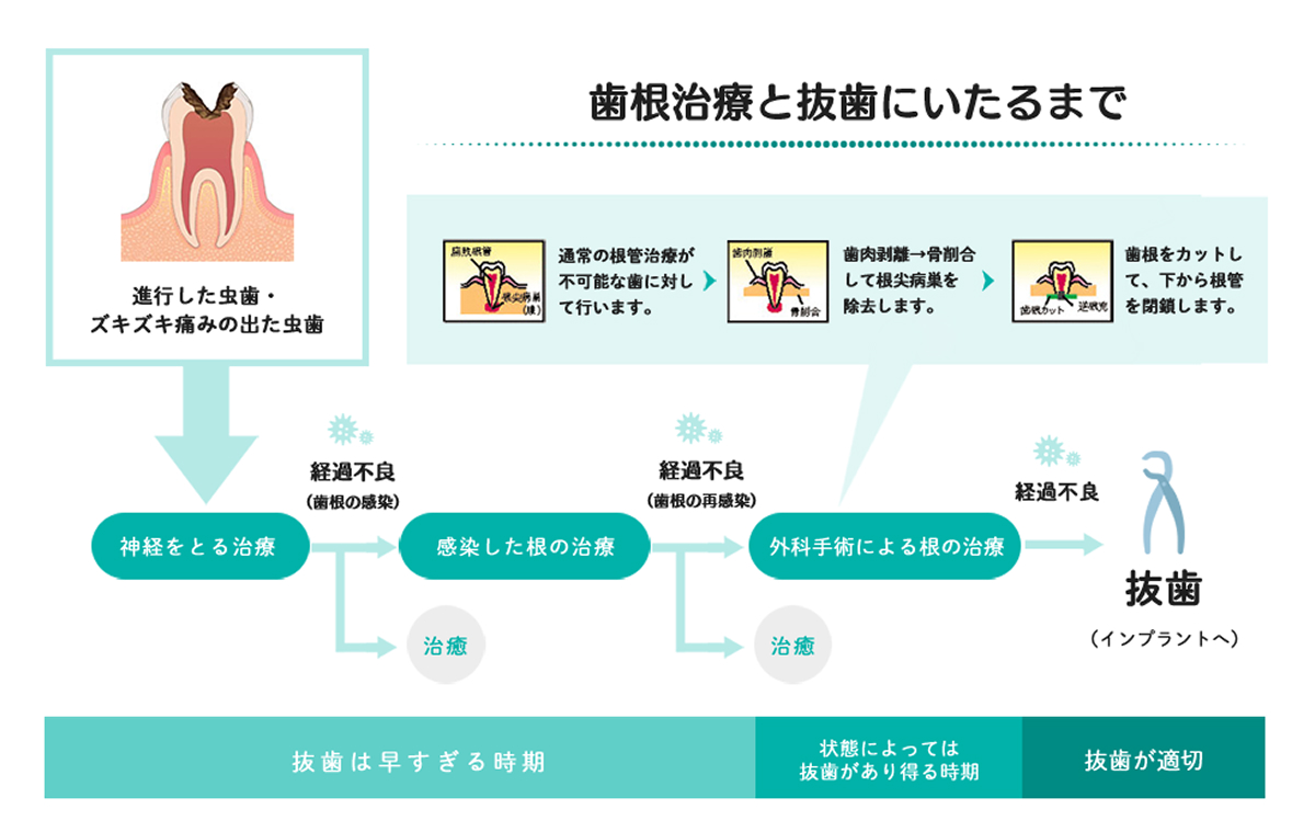 進行したむし歯から歯根治療、外科的根の治療を経て、最終的に抜歯に至るまでの流れを示す図。神経を取る治療や感染した根の治療で治癒する場合もあるが、歯根の再感染などで経過不良の場合は外科的治療を行い、それでも改善しない場合は抜歯（インプラント治療など）に進む可能性があることを示している。